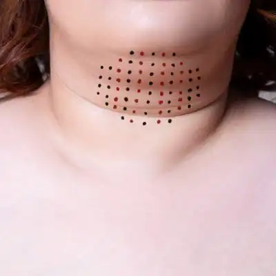 Double chin reduction